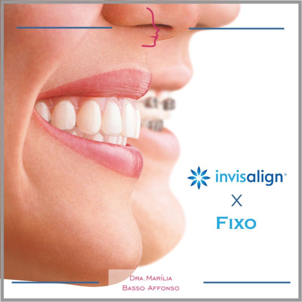 Aparelho Fixo ou Invisalign? – Dra. Marilia Basso Affonso